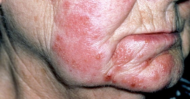 shingles on face of female patient | what does shingles look like