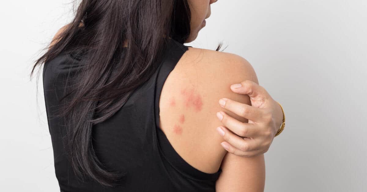 woman scratching back | shingles treatment